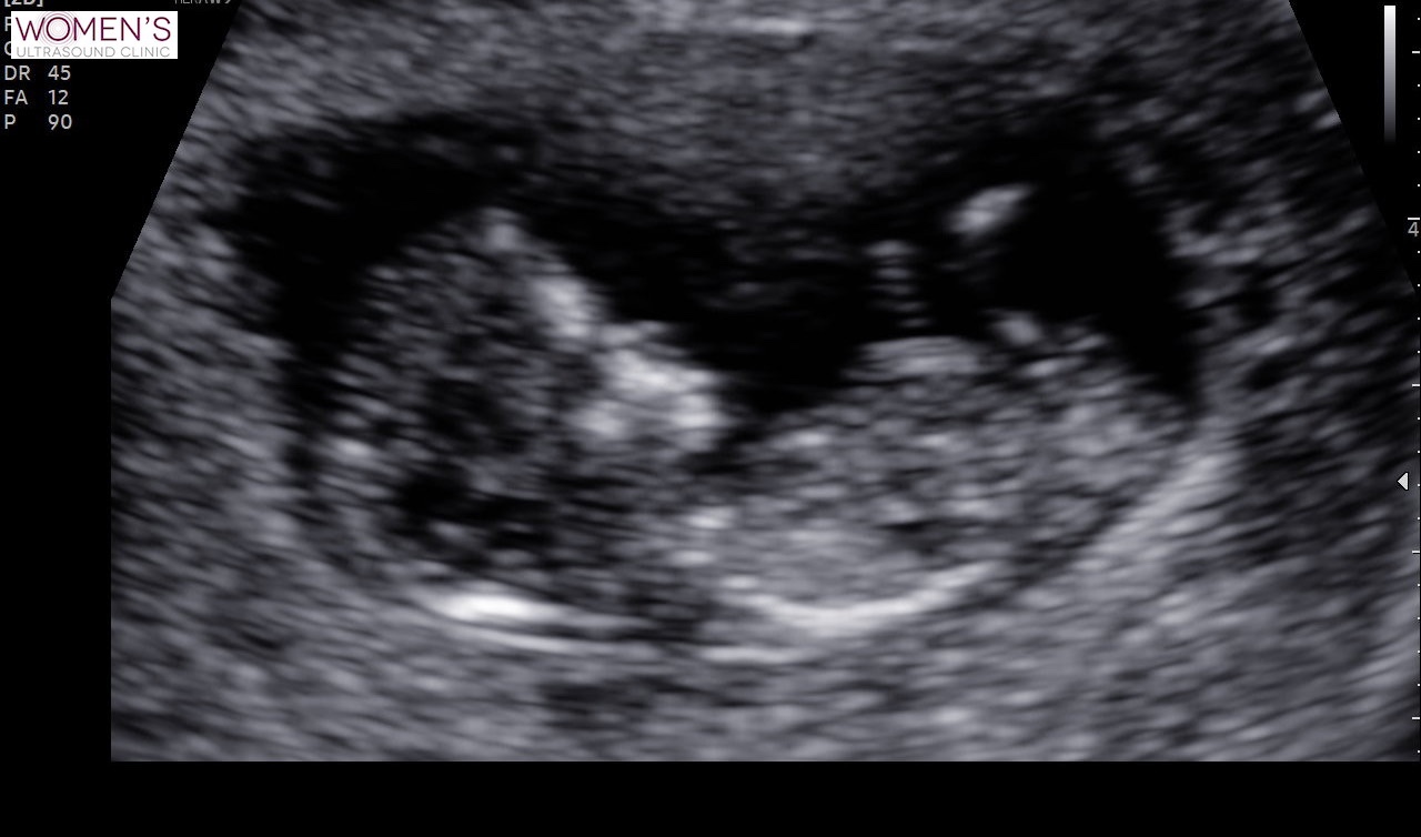 Week 36 Pregnancy Update